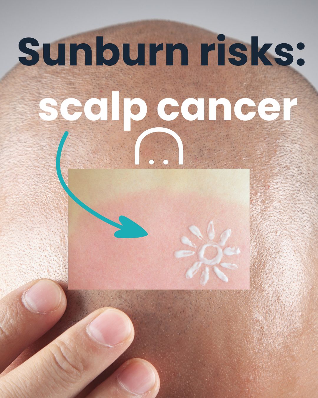 Scalp Cancer in Bald Men: Understanding the Risks of Sunburn and How to Protect Yourself