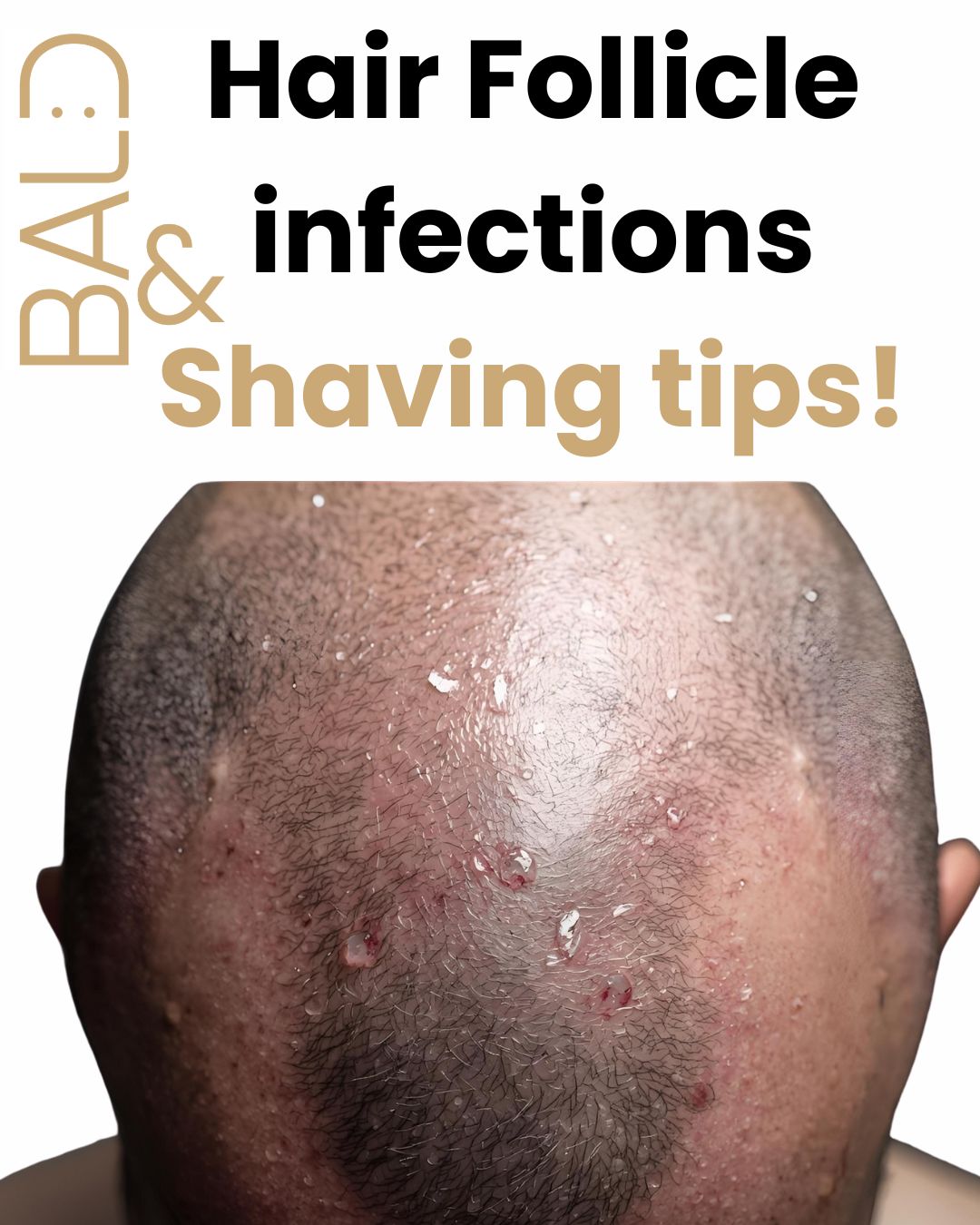 Effectively Managing Folliculitis: Tips for Shaving a Bald Head